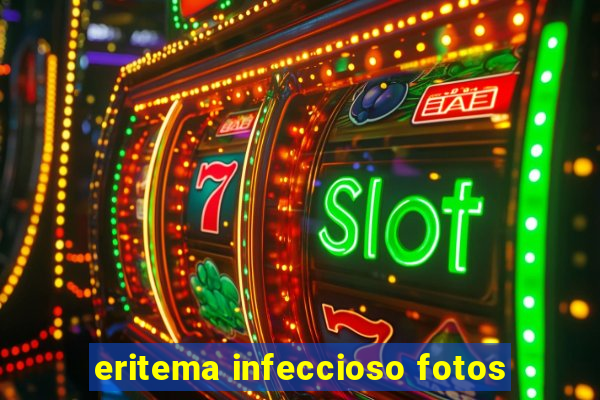 eritema infeccioso fotos